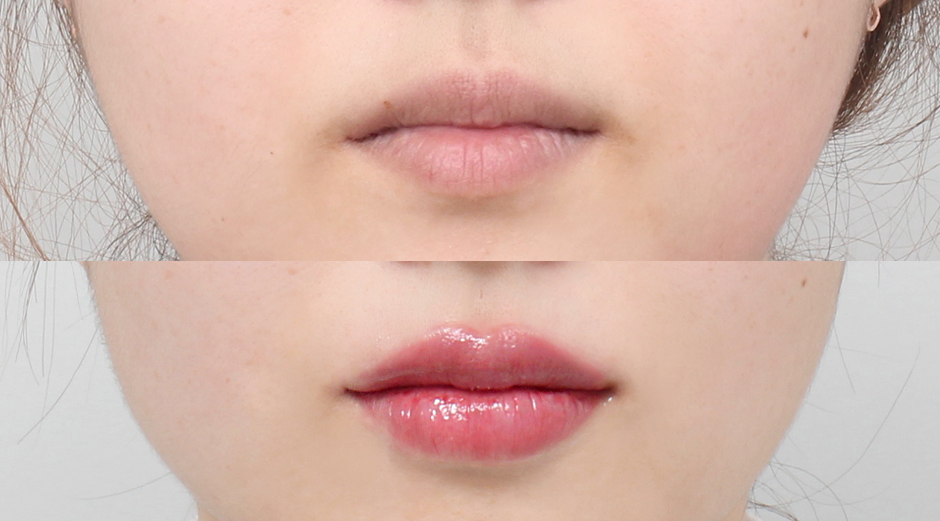 입술필러 시술 전후