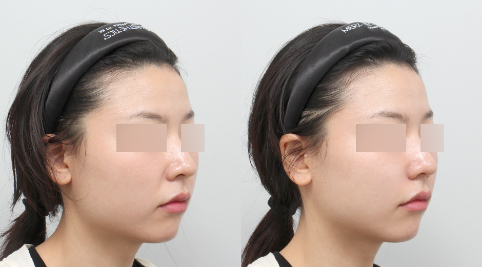 쥬베룩볼륨 전후 시술 후 1주차