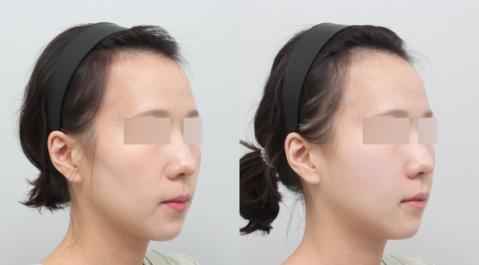 쥬베룩볼륨 전후 시술 후 1주차