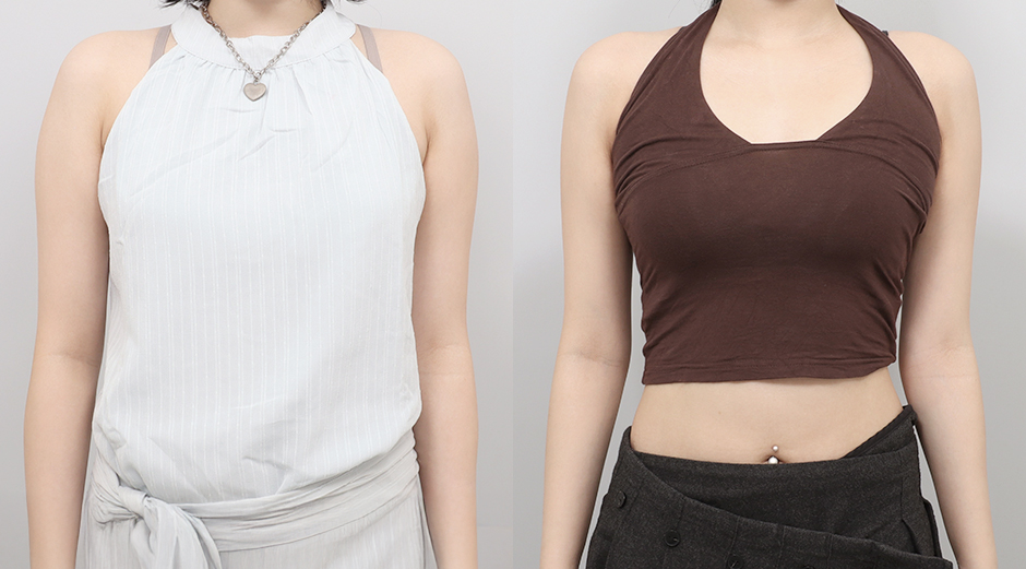 바디 에이빼주사 전후 시술 후 1개월