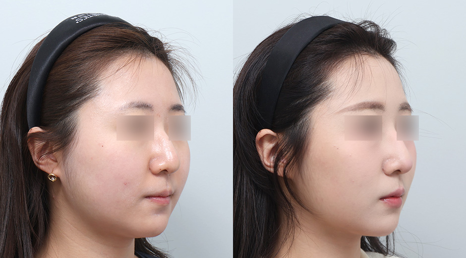 에이빼주사 (얼굴) 전후 시술 후 1개월