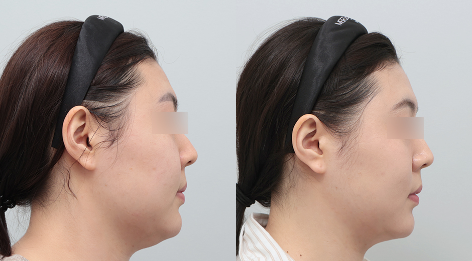 실리프팅 전후 시술 후 1개월