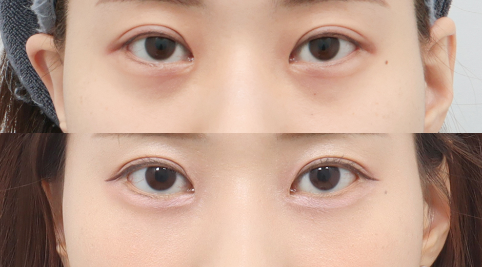 에이빛아이 전후 시술 후 1개월