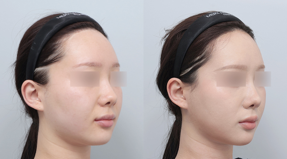 울쎄라 전후 시술 후 1개월