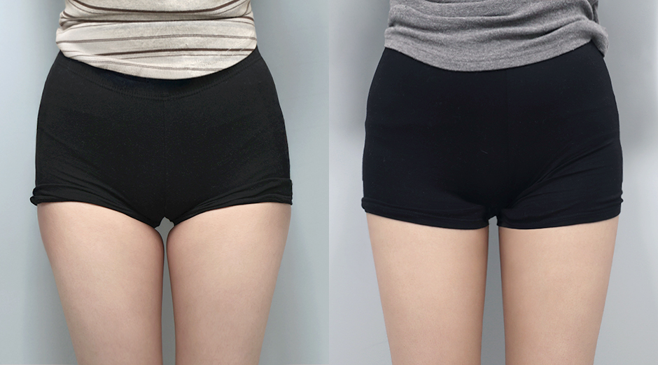 바디 에이빼주사 전후 시술 후 1개월