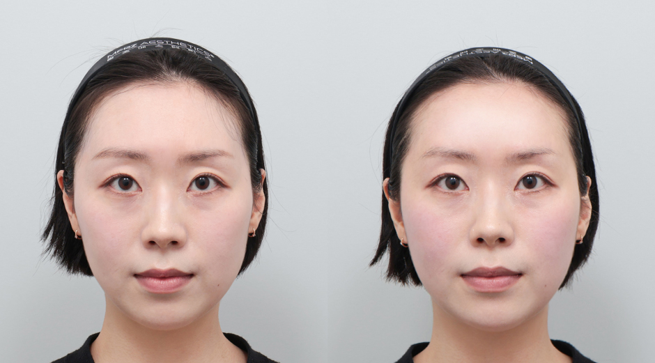 이마필러 시술 전후