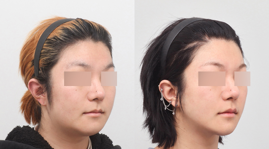 울쎄라 전후 시술 후 1개월