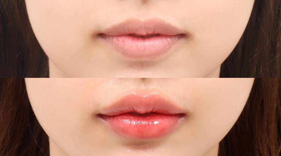 입술필러 시술 전후