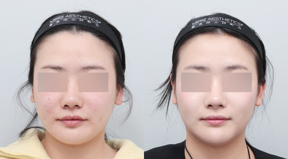 울쎄라 시술 전후, 써마지 시술 전후, 리쥬란 시술 전후