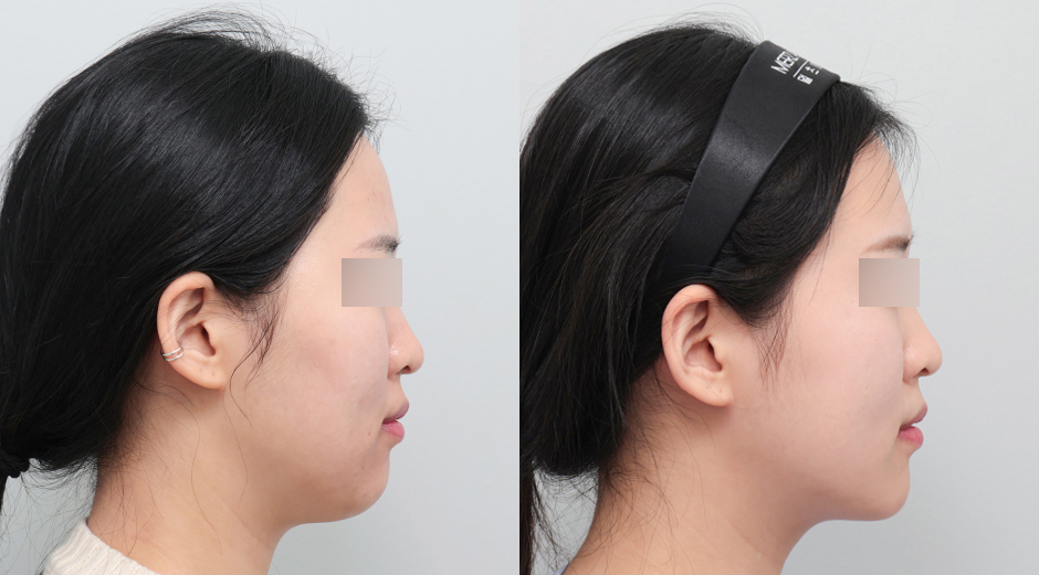 옆볼 쥬베룩 시술 전후, 울쎄라 시술 전후 측면