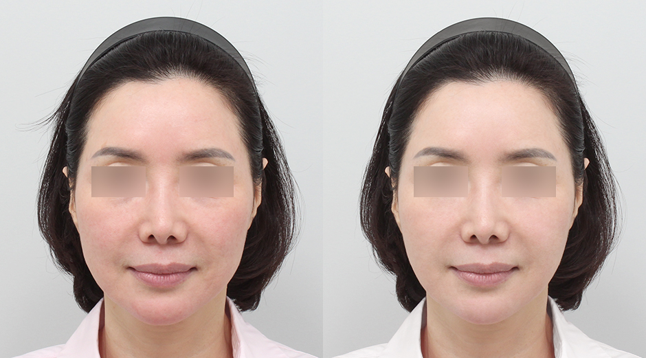 포텐자 전후, 레스노베크리스탈 전후 시술 후 1개월