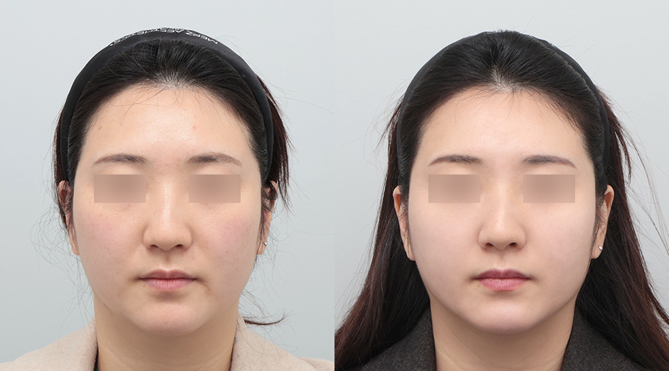 줄기세포 시술 전후