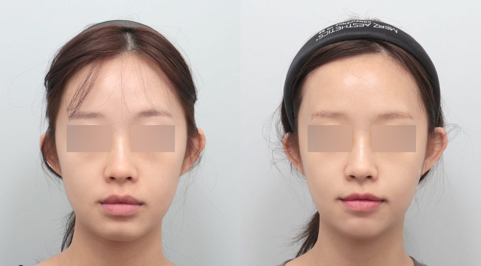 얼굴에이빼주사 시술 전후