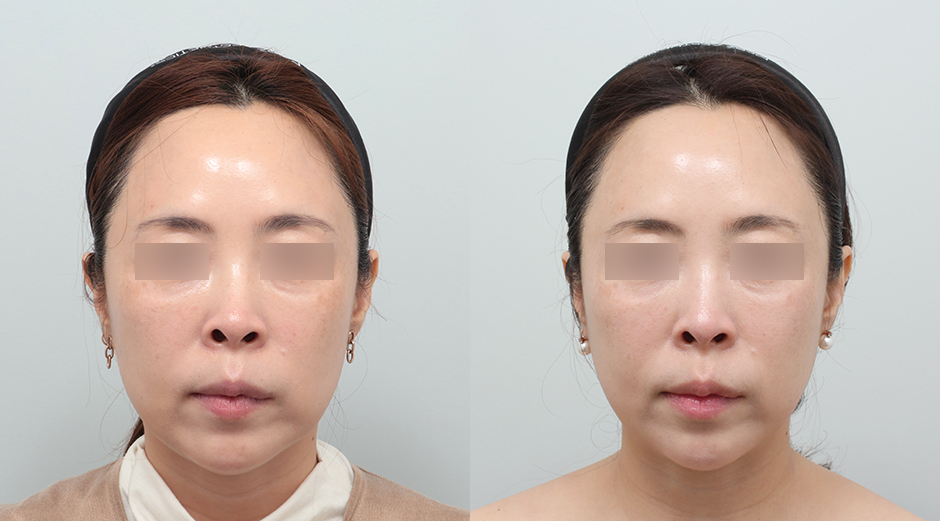 울쎄라 시술 전후