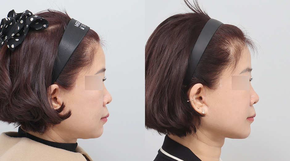 쥬베룩볼륨 전후 시술 후 1개월