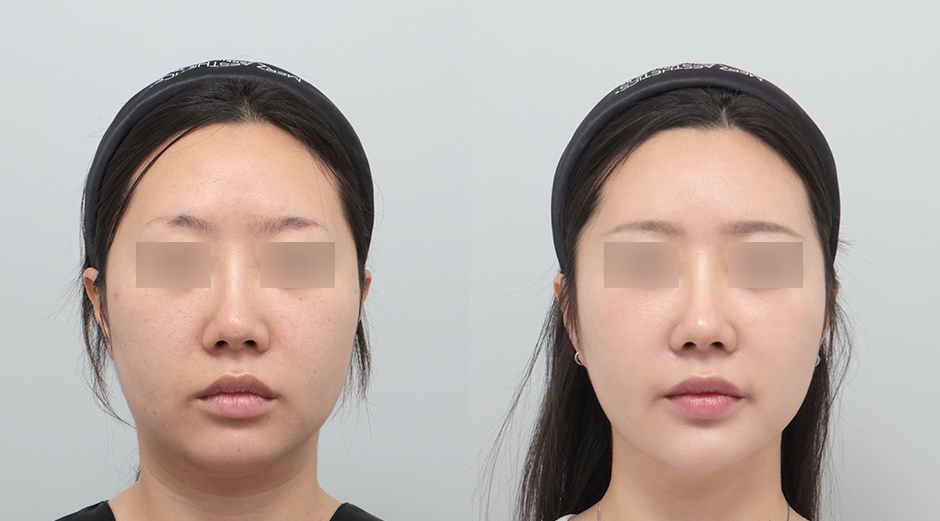 울쎄라 시술 전후, 줄기세포피부주사 시술 전후, 얼굴에이빼 시술 전후