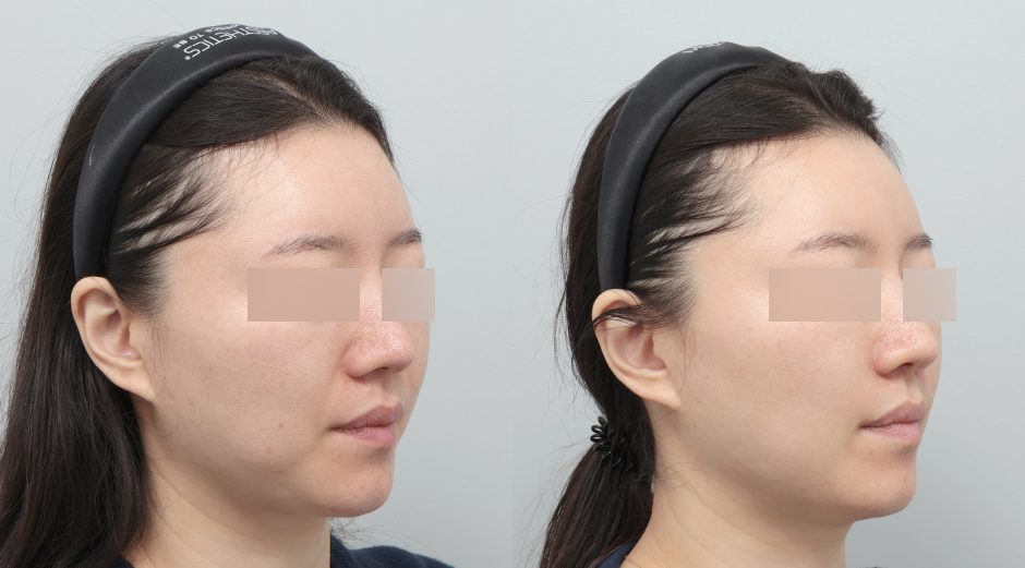 쥬베룩볼륨 시술 전후 45도