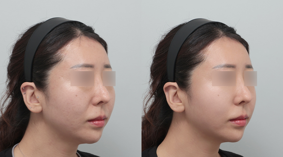 포텐자 전후, 레스노베크리스탈 전후 시술 후 1개월