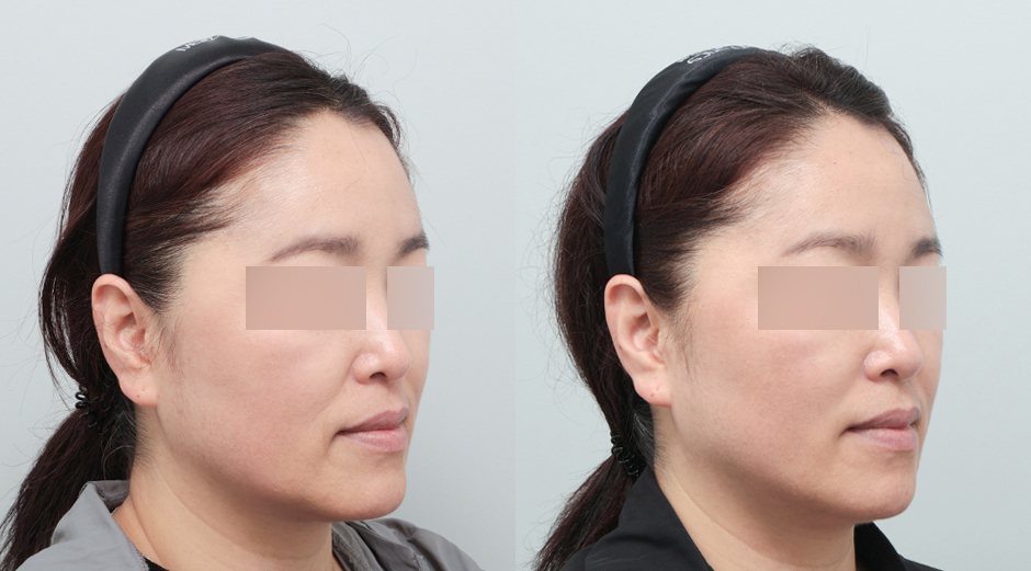 울쎄라 전후, 슈링크 전후, 레스노베 크리스탈 전후 시술 후 1개월