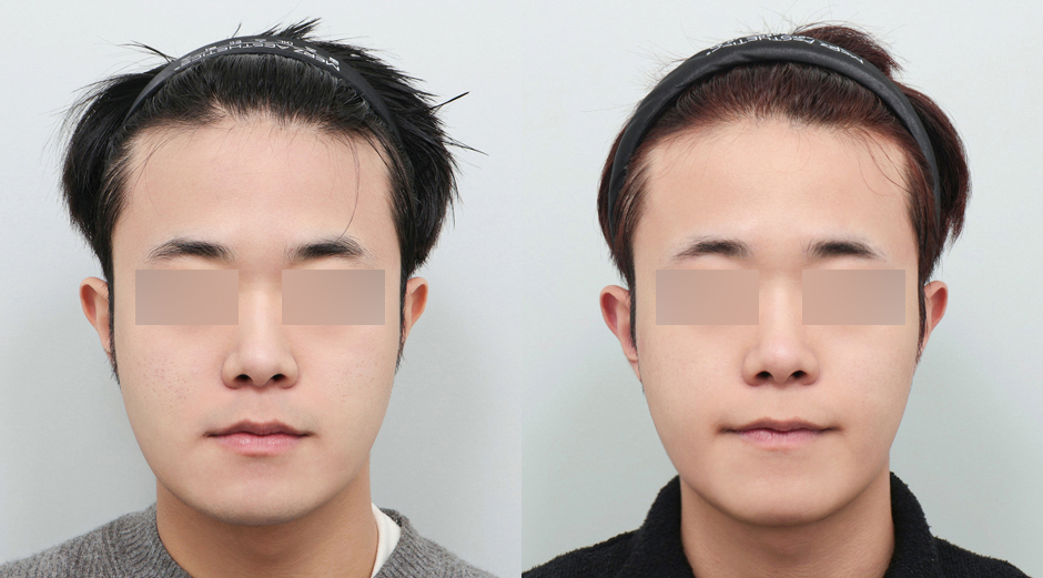 큐어젯 시술 전후, 쥬베룩 시술 전후 정면