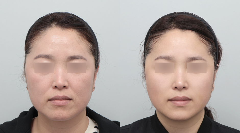 실리프팅 전후 시술 후 1개월