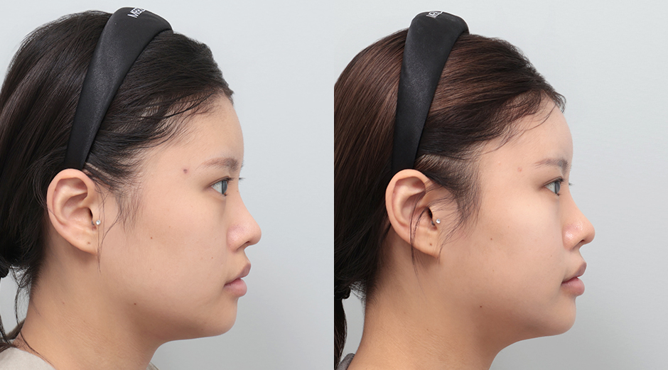 울쎄라 전후, 리쥬란 전후 시술 후 1개월