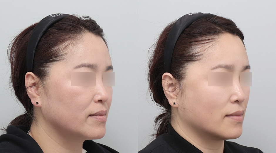 실리프팅 전후 시술 후 1개월