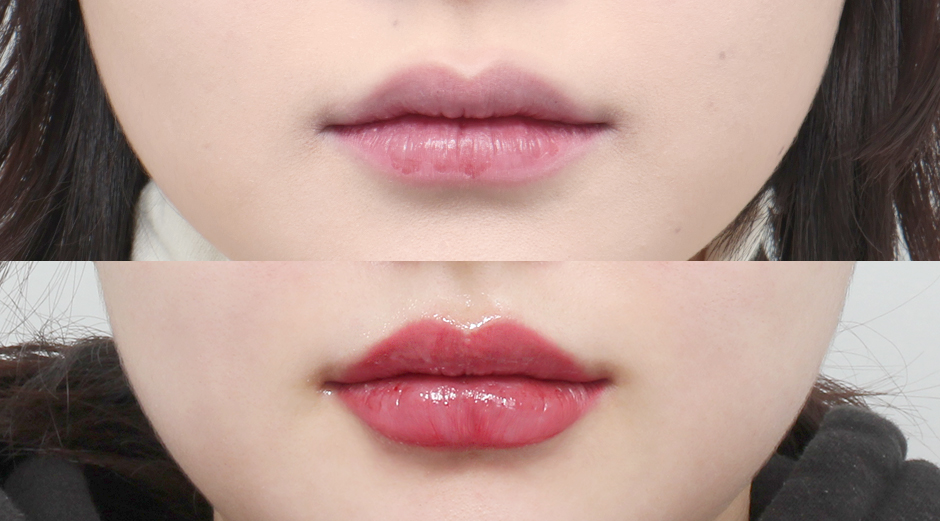 입술필러 시술 전후