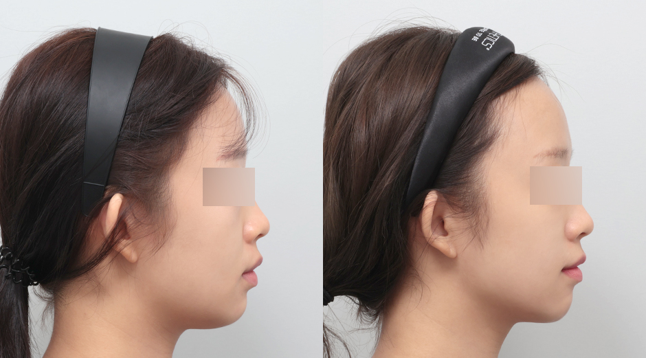 얼굴에이빼주사 전후 시술 후 1개월