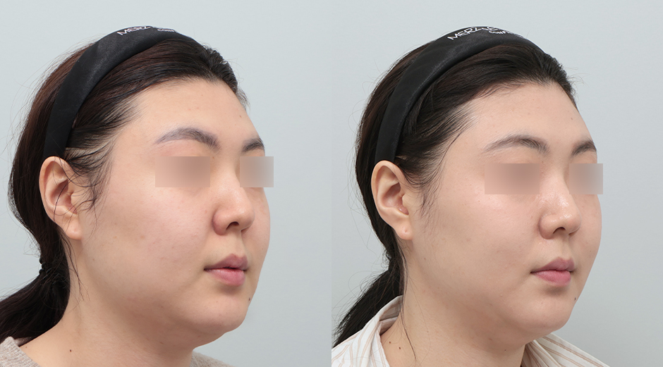 실리프팅 전후 시술 후 1개월