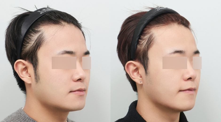 큐어젯 시술 전후, 쥬베룩 시술 전후 45도