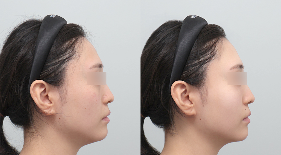 엘라비에리투오 전후 시술 후 1개월