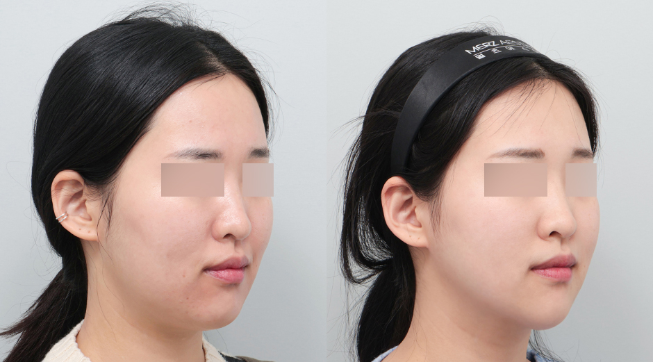 옆볼 쥬베룩 시술 전후, 울쎄라 시술 전후 45도