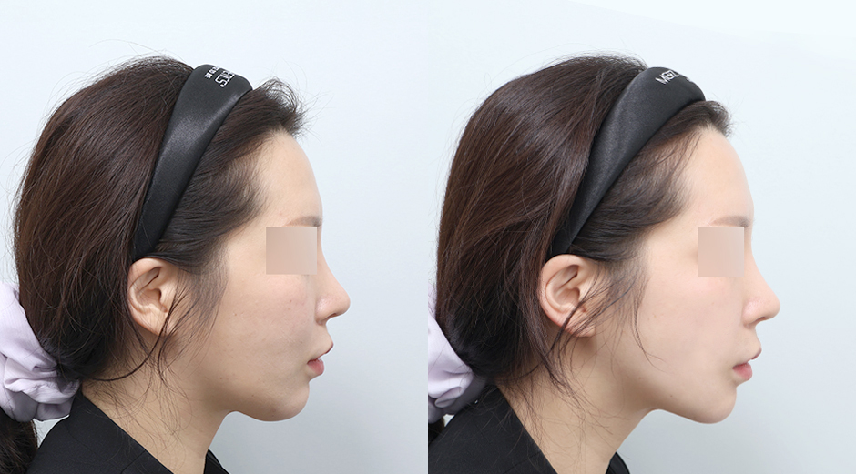 온다리프팅 (얼굴) 전후 시술 후 1개월