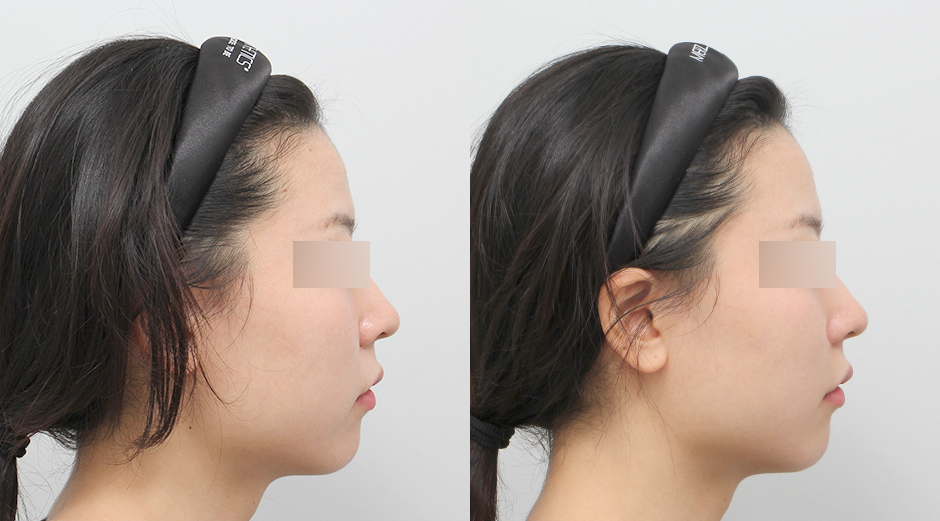 쥬베룩볼륨 전후 시술 후 1주차