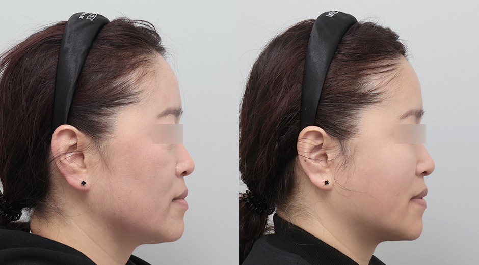 실리프팅 전후 시술 후 1개월