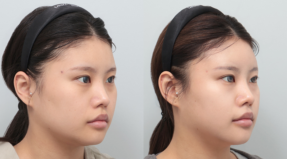 울쎄라 전후, 리쥬란 전후 시술 후 1개월