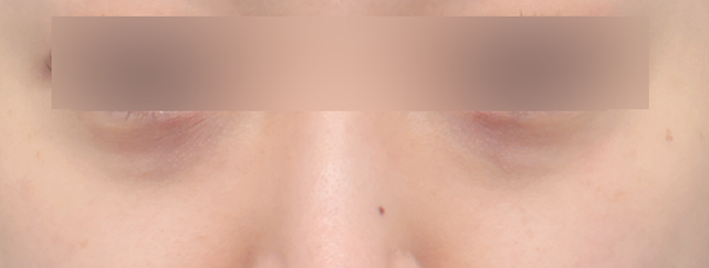 눈 주사 주입 전