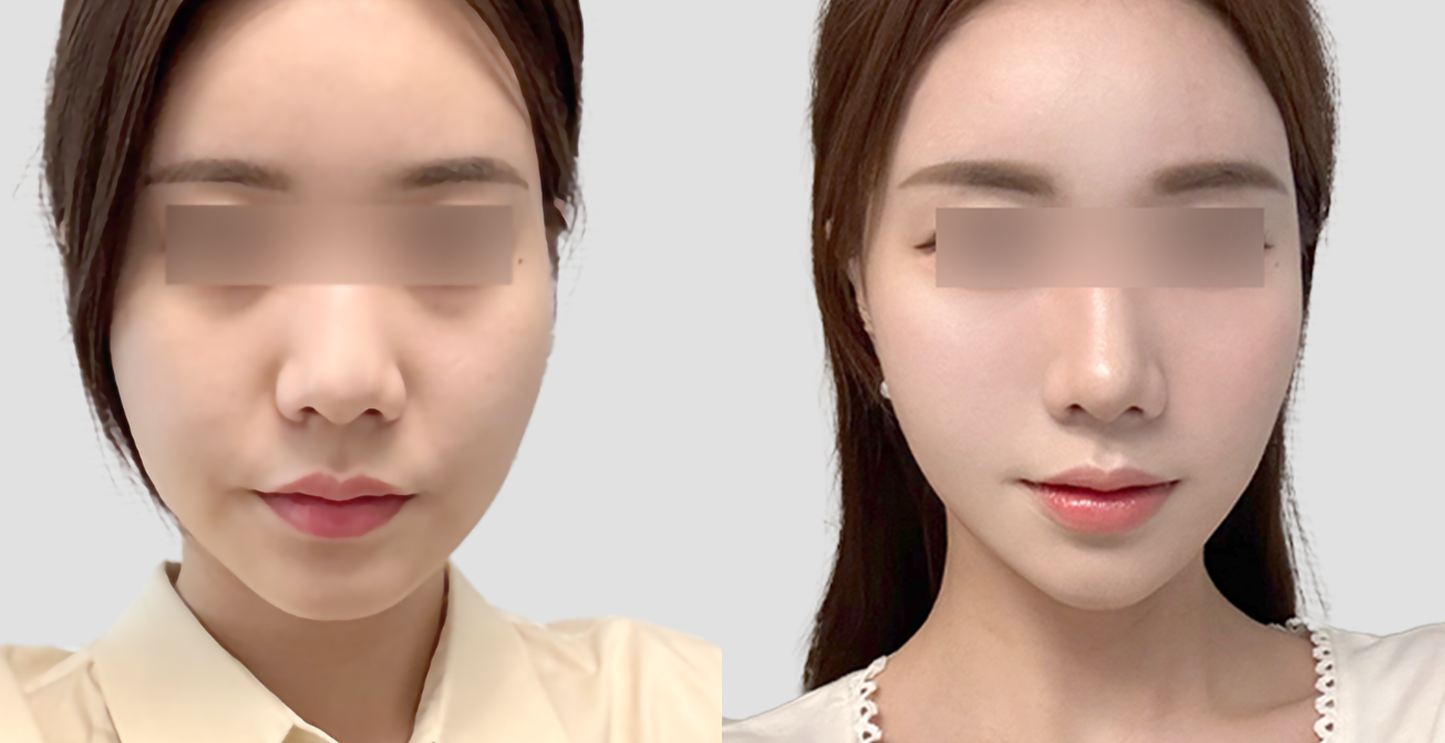 얼굴 주서 주입 전후