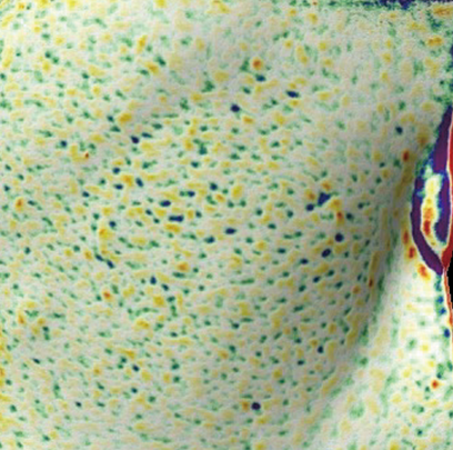 엘라비에 리투오 전후 - 에이비 피부과