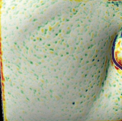 엘라비에 리투오 전후 - 에이비 피부과