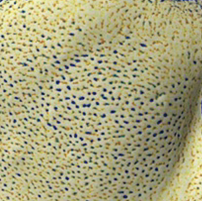 엘라비에 리투오 전후 - 에이비 피부과