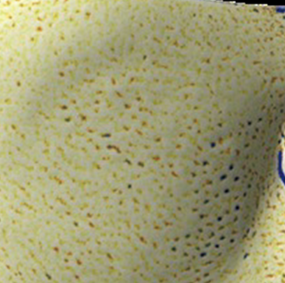 엘라비에 리투오 전후 - 에이비 피부과