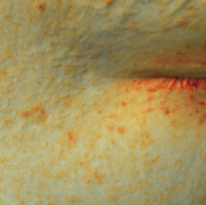 엘라비에 리투오 전후 - 에이비 피부과