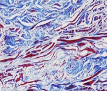 엘라비에 리투오 전후 - 에이비 피부과