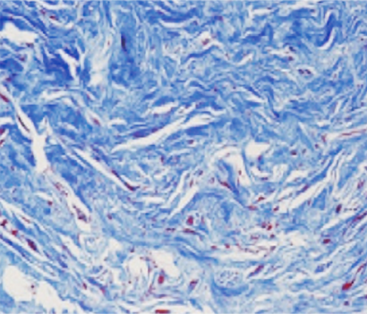 엘라비에 리투오 전후 - 에이비 피부과