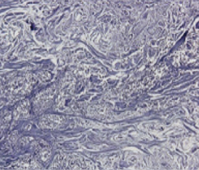 엘라비에 리투오 전후 - 에이비 피부과