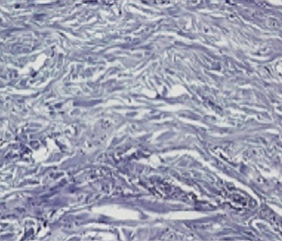 엘라비에 리투오 전후 - 에이비 피부과