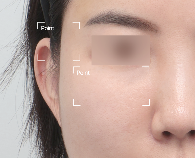 디자인 필러 전후 - 에이비 피부과