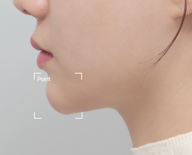 디자인 필러 전후 - 에이비 피부과